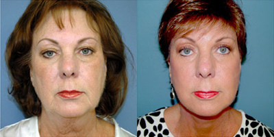 Facelift before and after photo
