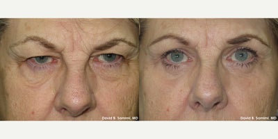 Ptosis Surgery before and after photo
