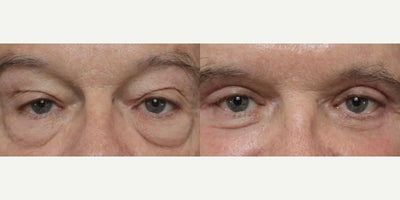 Eyelid Surgery before and after photo