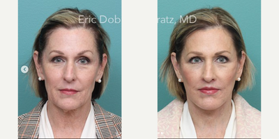 Facelift before and after photo