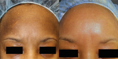 Laser Resurfacing before and after photo
