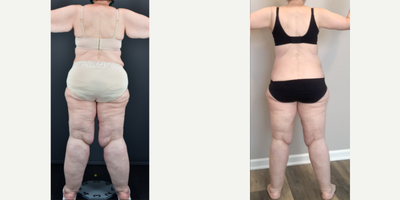 Lipo 360 before and after photo