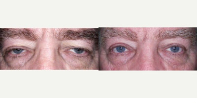Ptosis Surgery before and after photo