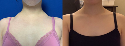 Botox before and after photo