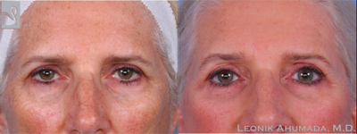 Eyelid Surgery before and after photo