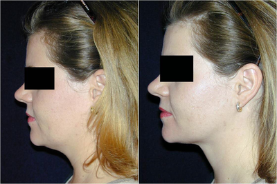 Neck Lift before and after photo