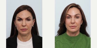 Neck Lift before and after photo
