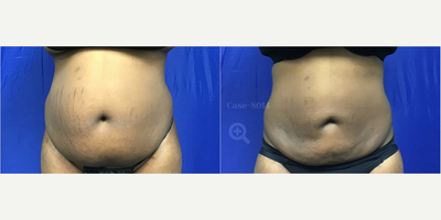 Renuvion before and after photo