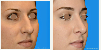 Rhinoplasty before and after photo