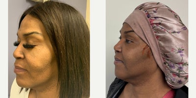 Rhinoplasty before and after photo