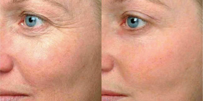 Skin Rejuvenation before and after photo