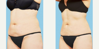 CoolSculpting before and after photo