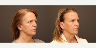 Eyelid Surgery before and after photo