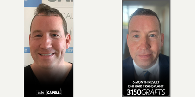 Hair Transplant before and after photo