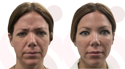 Liquid Facelift before and after photo