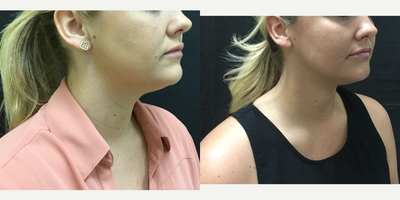 CoolSculpting before and after photo