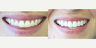 Da Vinci Veneers before and after photo