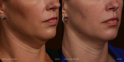 Kybella before and after photo
