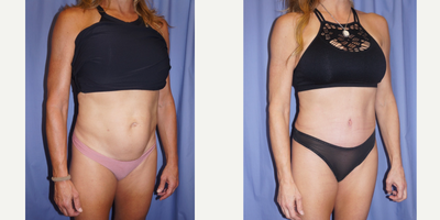 Tummy Tuck before and after photo