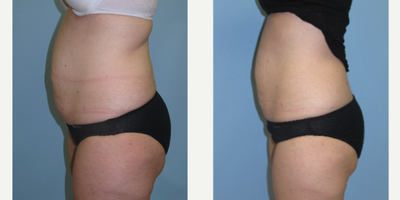 UltraShape Power before and after photo