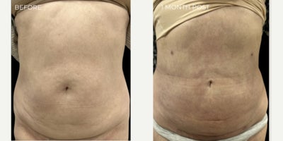 Vaser Liposuction before and after photo