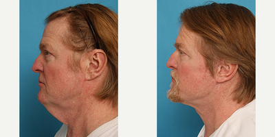 Facelift before and after photo