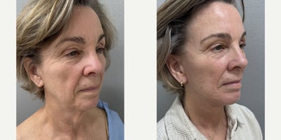 Facelift before and after photo