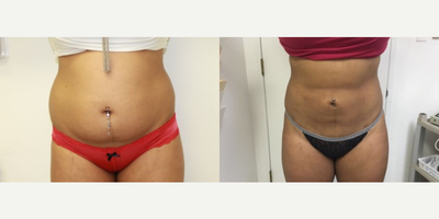 Liposuction before and after photo