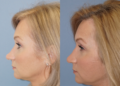 Rhinoplasty before and after photo
