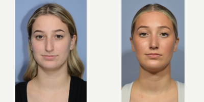 Rhinoplasty before and after photo