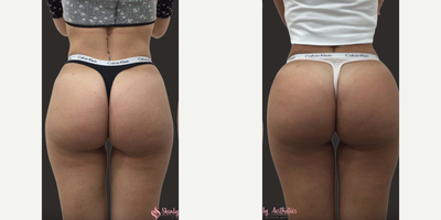 Sculptra before and after photo