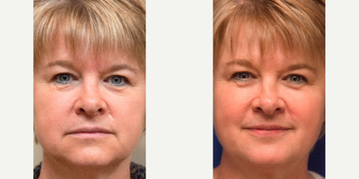 Scar Removal before and after photo