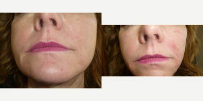 Vollure before and after photo