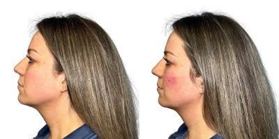 Dermal Fillers before and after photo
