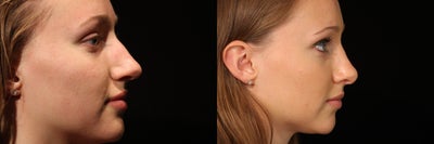 Rhinoplasty before and after photo