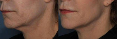Ultherapy before and after photo