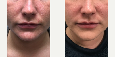 Venus Viva before and after photo