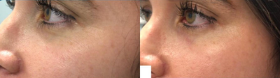 Volbella before and after photo