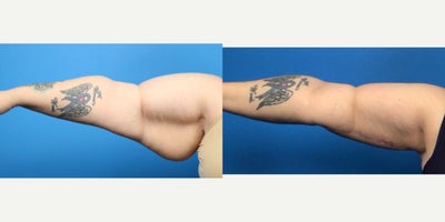 Arm Lift before and after photo
