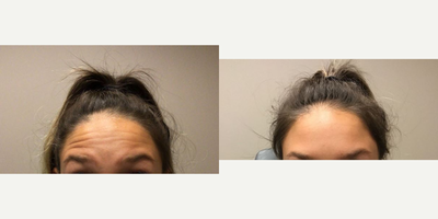 Botox before and after photo