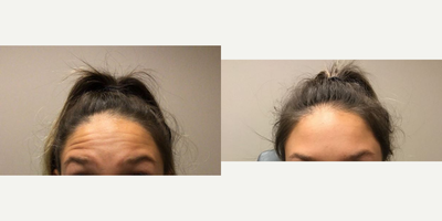 Botox before and after photo