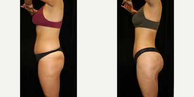 Brazilian Butt Lift before and after photo