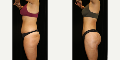 Brazilian Butt Lift before and after photo