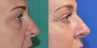 Eyelid Surgery before and after photo