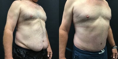 Male Tummy Tuck before and after photo