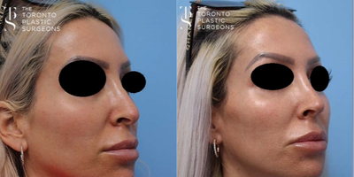 Rhinoplasty before and after photo
