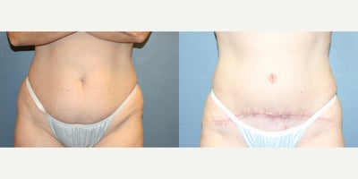 Tummy Tuck before and after photo