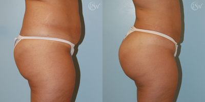 Brazilian Butt Lift before and after photo