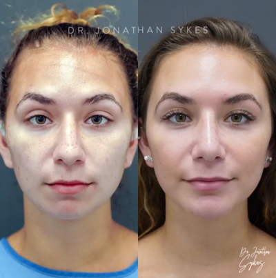 Chin Implant before and after photo