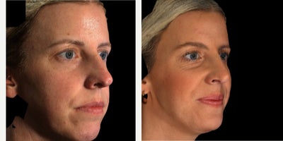 Chin Implant before and after photo
